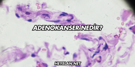 Adenokanser Nedir?