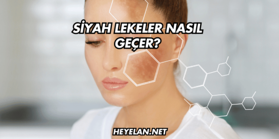 Siyah Lekeler Nasıl Geçer?