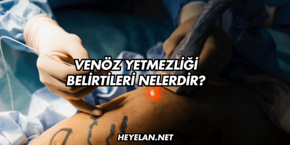 Venöz Yetmezliği Belirtileri Nelerdir?